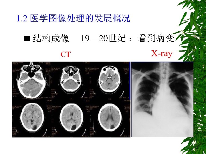 1. 2 医学图像处理的发展概况 n 结构成像 19— 20世纪 ：看到病变 CT X-ray 