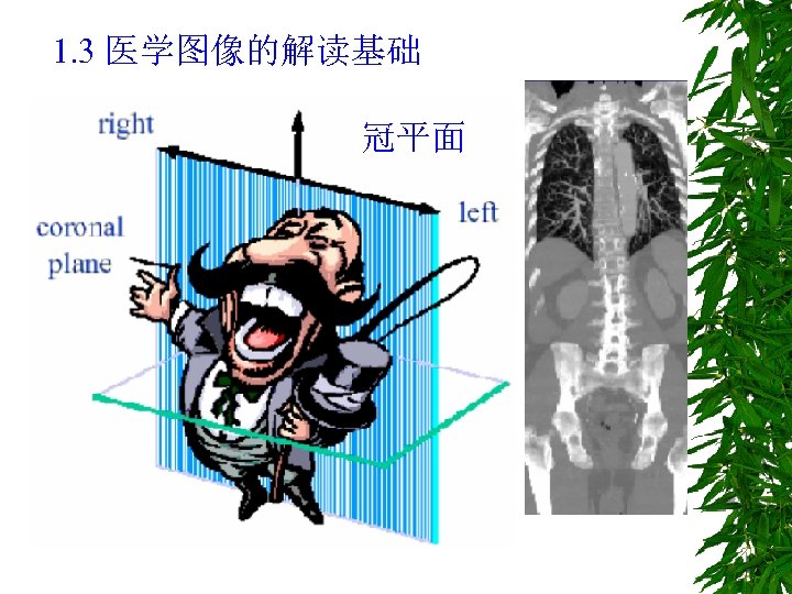 1. 3 医学图像的解读基础 冠平面 