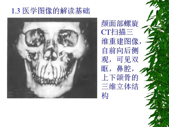 1. 3 医学图像的解读基础 颜面部螺旋 CT扫描三 维重建图像， 自前向后侧 观，可见双 眶，鼻腔， 上下颌骨的 三维立体结 构 