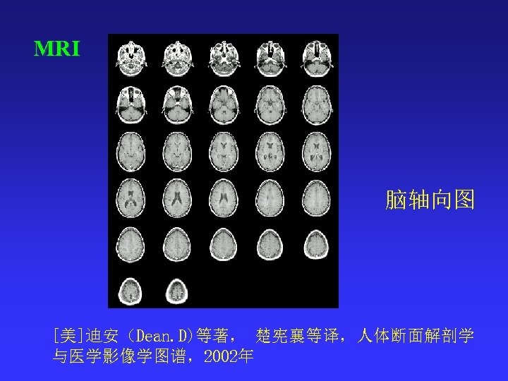 MRI 脑轴向图 [美]迪安（Dean. D)等著， 楚宪襄等译，人体断面解剖学 与医学影像学图谱，2002年 