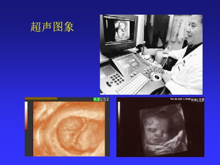 超声图象 