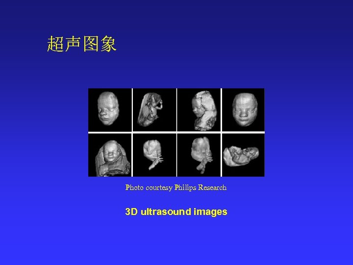 超声图象 Photo courtesy Philips Research 3 D ultrasound images 