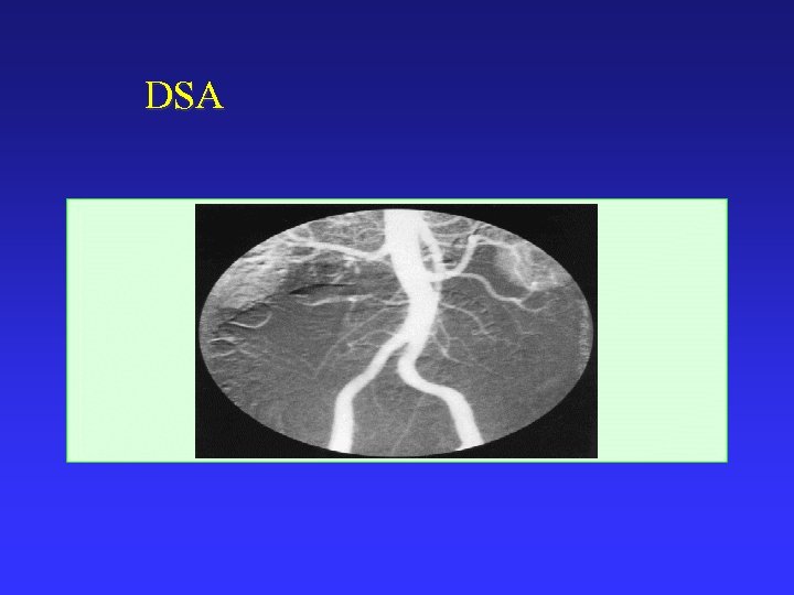 DSA 