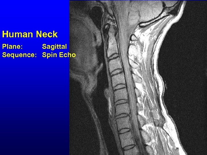 Human Neck Plane: Sagittal Sequence: Spin Echo 