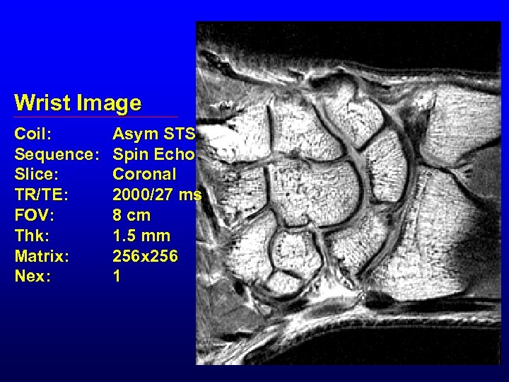 Wrist Image Coil: Sequence: Slice: TR/TE: FOV: Thk: Matrix: Nex: Asym STS Spin Echo