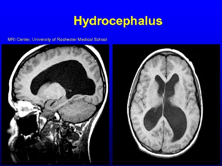 Hydrocephalus MRI Center, University of Rochester Medical School 