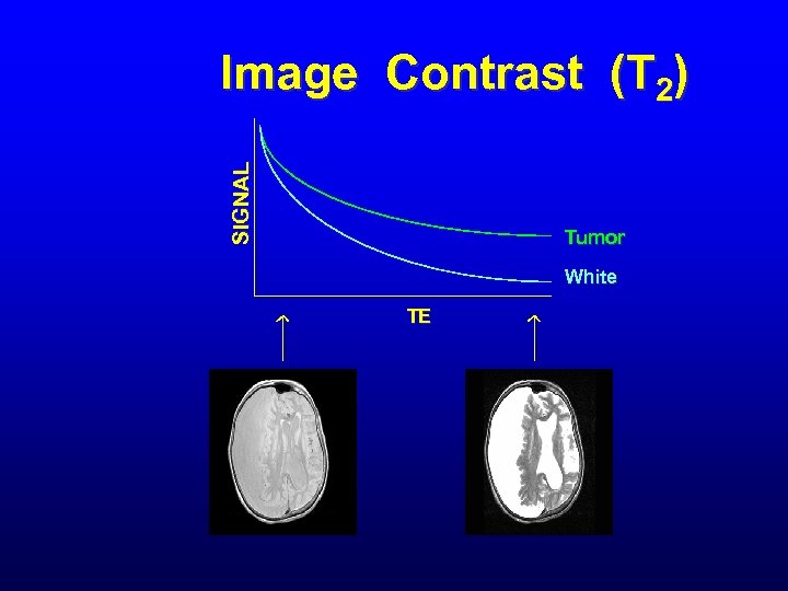 SIGNAL Image Contrast (T 2) Tumor White TE 