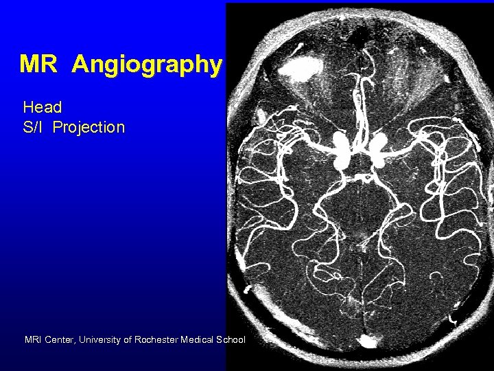 MR Angiography Head S/I Projection MRI Center, University of Rochester Medical School 