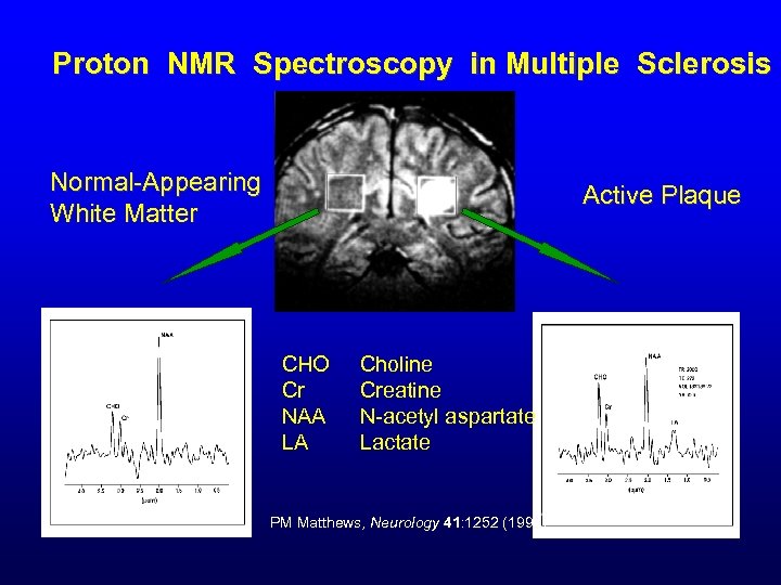 Proton NMR Spectroscopy in Multiple Sclerosis Normal-Appearing White Matter Active Plaque CHO Cr NAA