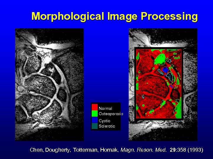 Morphological Image Processing Normal Osteoporosis Cystic Sclerotic Chen, Dougherty, Totterman, Hornak, Magn. Reson. Med.