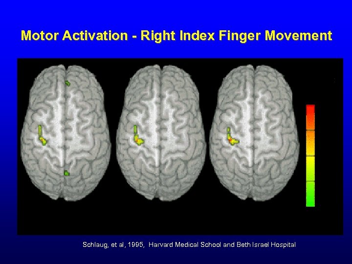 Motor Activation - Right Index Finger Movement % 100 75 5 0 25 1