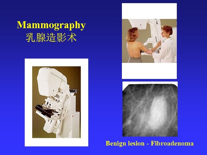 Mammography 乳腺造影术 Benign lesion - Fibroadenoma 