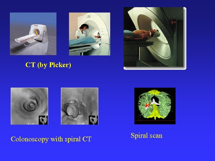 CT (by Picker) Colonoscopy with spiral CT Spiral scan 