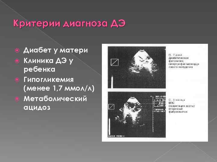 Критерии диагноза ДЭ Диабет у матери Клиника ДЭ у ребенка Гипогликемия (менее 1, 7