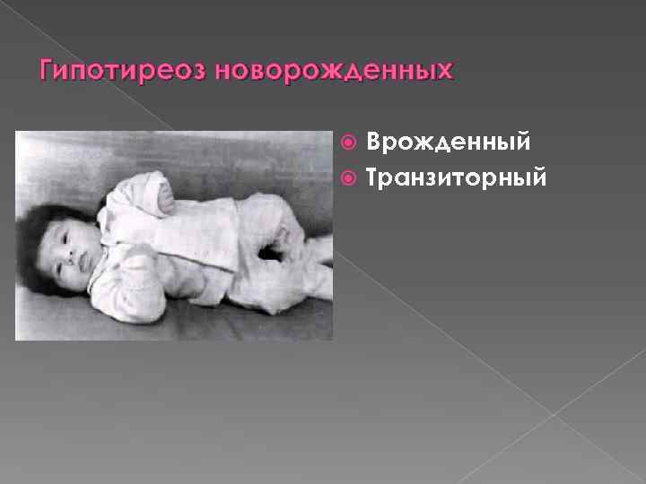 Гипотиреоз новорожденных Врожденный Транзиторный 