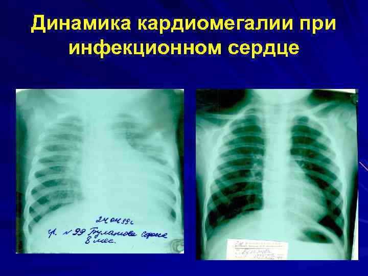 Динамика кардиомегалии при инфекционном сердце 
