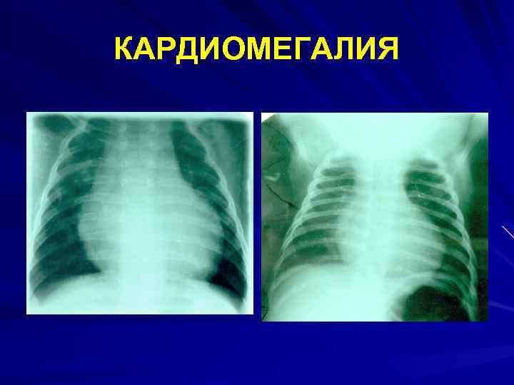 КАРДИОМЕГАЛИЯ 
