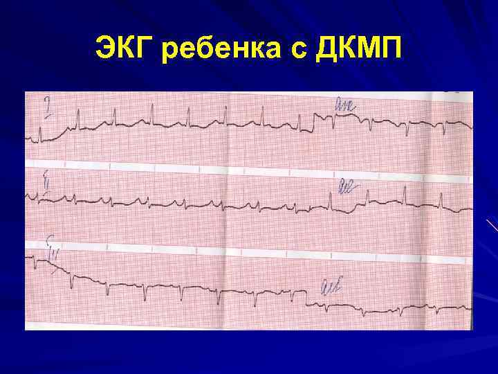 ЭКГ ребенка с ДКМП 