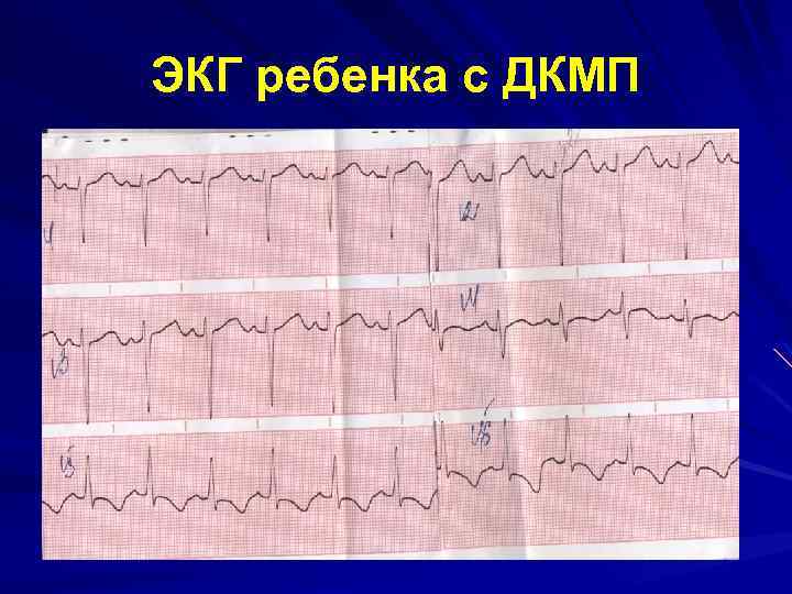 Экг при дилатационной кардиомиопатии фото