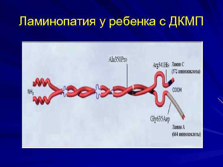 Ламинопатия у ребенка с ДКМП 