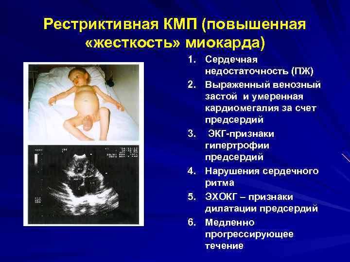 Рестриктивная КМП (повышенная «жесткость» миокарда) 1. Сердечная недостаточность (ПЖ) 2. Выраженный венозный застой и