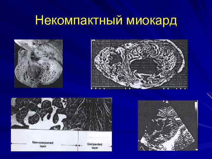 Некомпактный миокард 