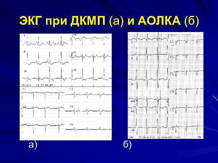 Экг при дилатационной кардиомиопатии фото