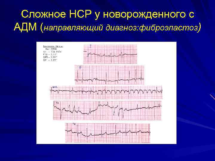 Сложное НСР у новорожденного с АДМ (направляющий диагноз: фиброэластоз) 