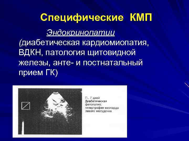 Специфические КМП Эндокринопатии (диабетическая кардиомиопатия, ВДКН, патология щитовидной железы, анте- и постнатальный прием ГК)