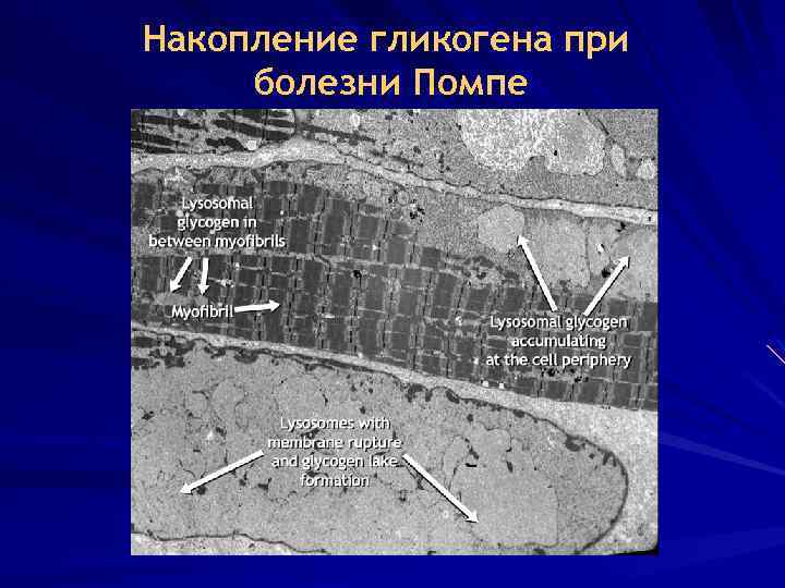 Накопление гликогена при болезни Помпе Data on file, Genzyme Corporation. 