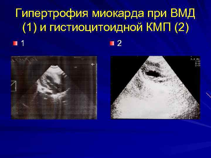 Гипертрофия миокарда при ВМД (1) и гистиоцитоидной КМП (2) 1 2 
