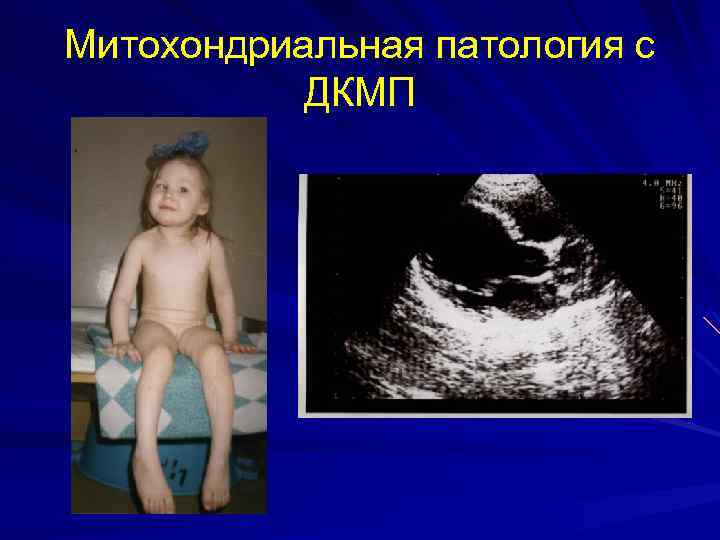 Митохондриальная патология с ДКМП 