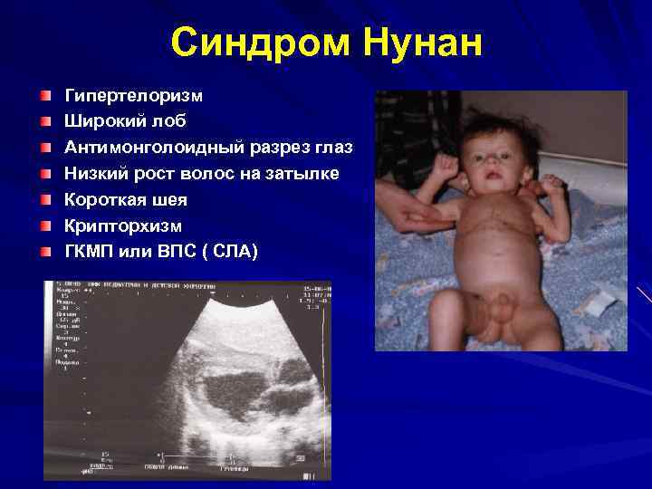 Синдром Нунан Гипертелоризм Широкий лоб Антимонголоидный разрез глаз Низкий рост волос на затылке Короткая