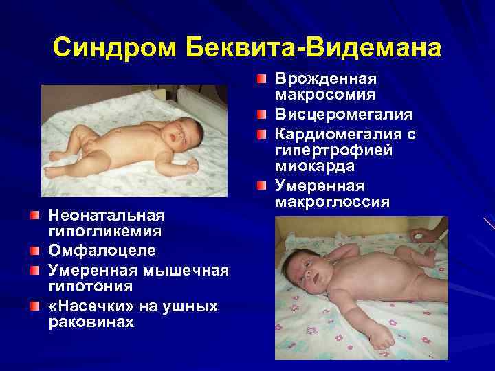 Синдром Беквита-Видемана Неонатальная гипогликемия Омфалоцеле Умеренная мышечная гипотония «Насечки» на ушных раковинах Врожденная макросомия