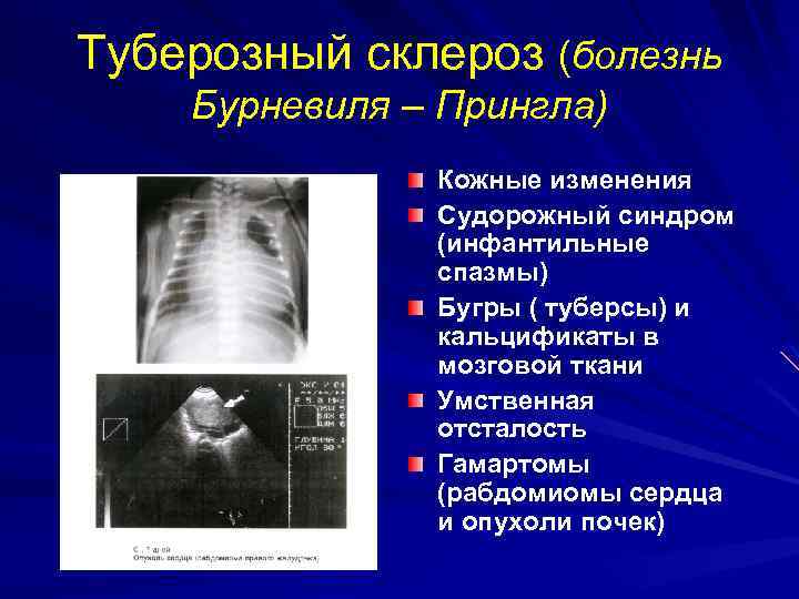 Туберозный склероз (болезнь Бурневиля – Прингла) Кожные изменения Судорожный синдром (инфантильные спазмы) Бугры (