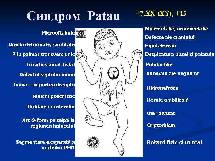 Синдром Patau Microoftalmie Urechi deformate, surditate Pliu palmar transvers unic Triradius axial distal Defectul