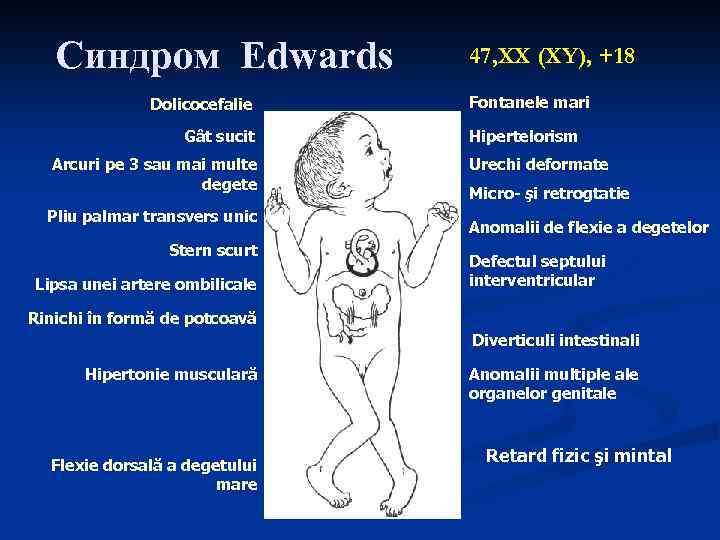 Синдром Edwards Dolicocefalie Gât sucit Arcuri pe 3 sau mai multe degete Pliu palmar