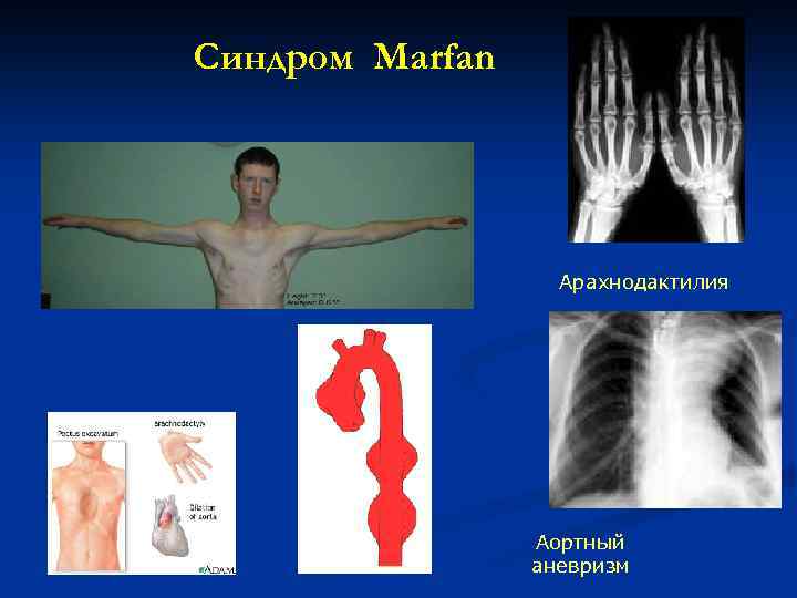 Синдром Marfan Арахнодактилия Аортный аневризм 