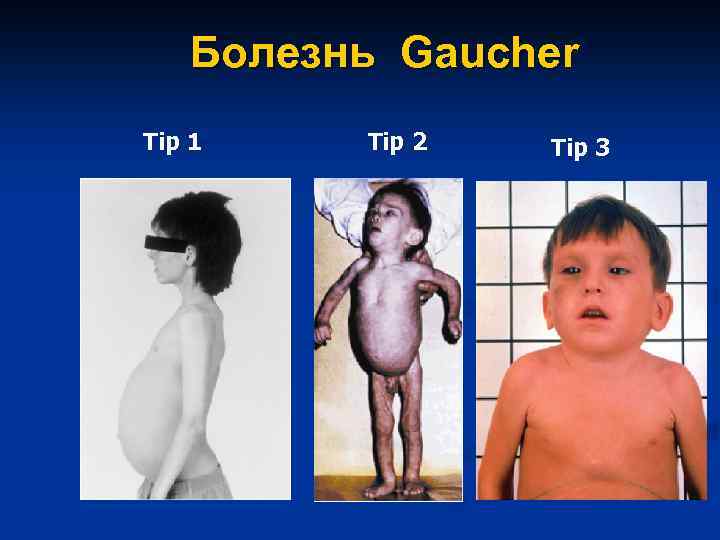 Болезнь Gaucher Tip 1 Tip 2 Tip 3 