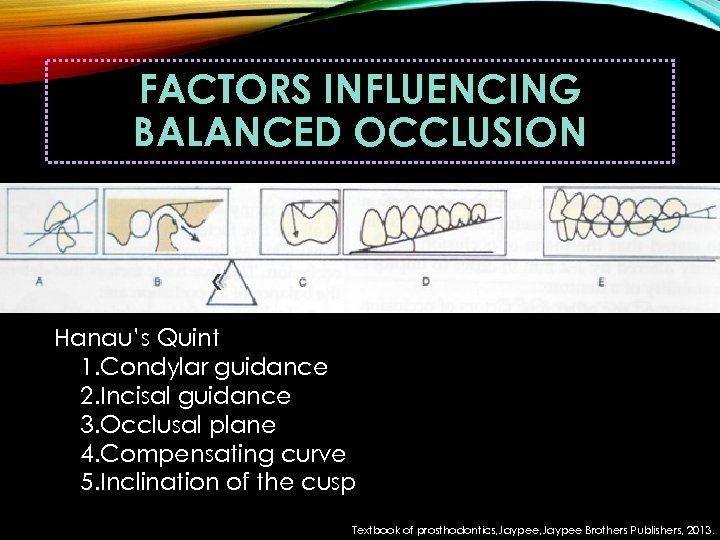 FACTORS INFLUENCING BALANCED OCCLUSION Hanau’s Quint 1. Condylar guidance 2. Incisal guidance 3. Occlusal