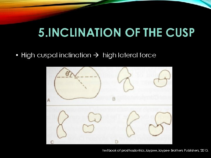 5. INCLINATION OF THE CUSP • High cuspal inclination high lateral force textbook of
