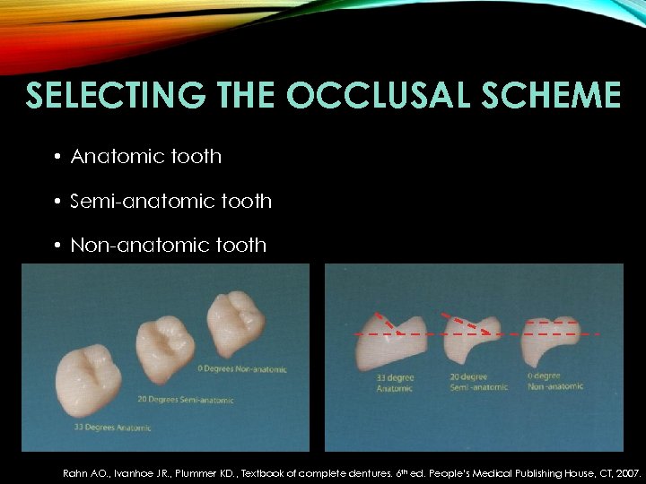SELECTING THE OCCLUSAL SCHEME • Anatomic tooth • Semi-anatomic tooth • Non-anatomic tooth Rahn