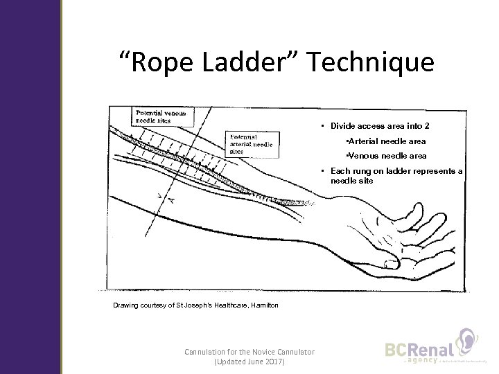 “Rope Ladder” Technique • Divide access area into 2 • Arterial needle area •