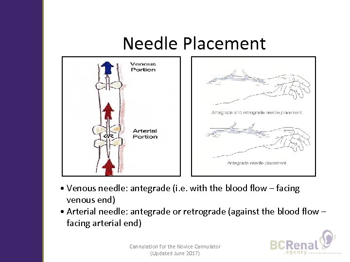 Needle Placement • Venous needle: antegrade (i. e. with the blood flow – facing