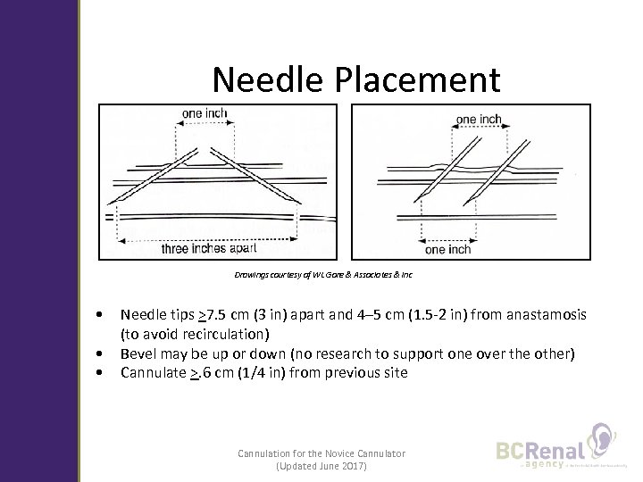 Needle Placement Drawings courtesy of WL Gore & Associates & Inc • • •