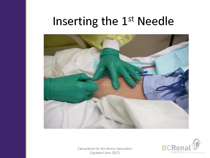 Inserting the 1 st Needle Cannulation for the Novice Cannulator (Updated June 2017) 