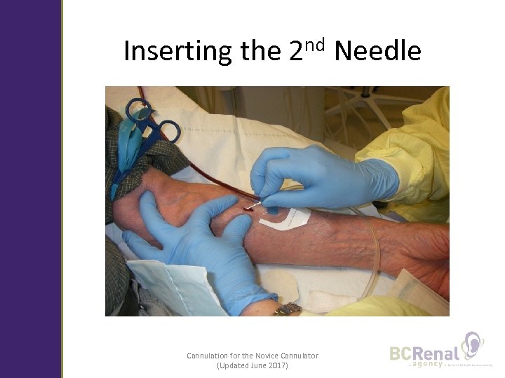 Inserting the 2 nd Needle Cannulation for the Novice Cannulator (Updated June 2017) 