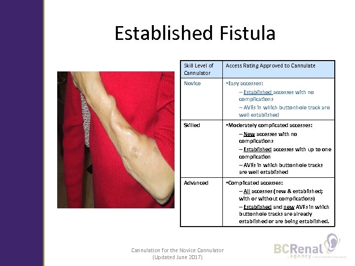 Established Fistula Skill Level of Cannulator Access Rating Approved to Cannulate Novice • Easy