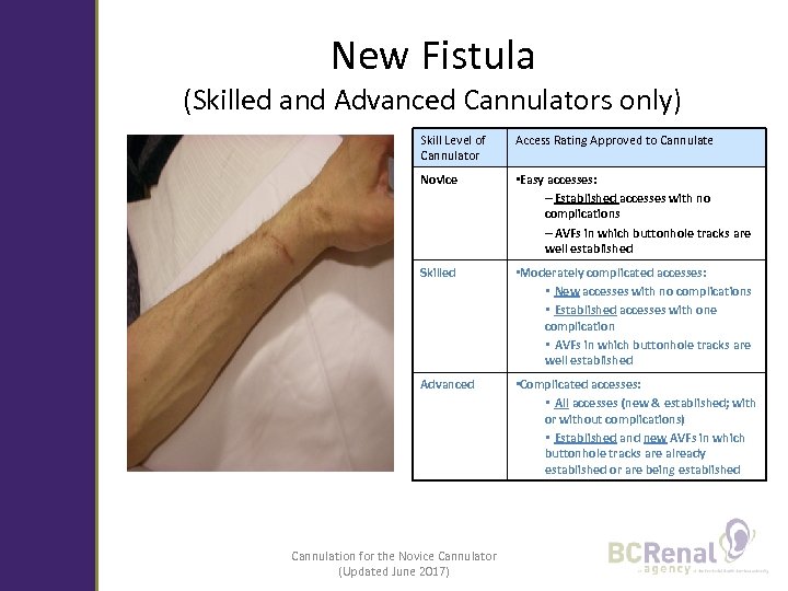 New Fistula (Skilled and Advanced Cannulators only) Skill Level of Cannulator Access Rating Approved