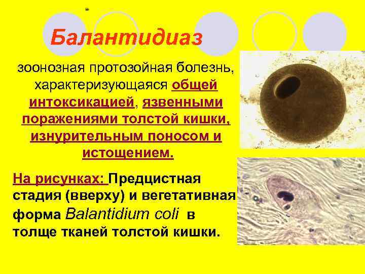 Балантидиаз зоонозная протозойная болезнь, характеризующаяся общей интоксикацией, язвенными поражениями толстой кишки, изнурительным поносом и